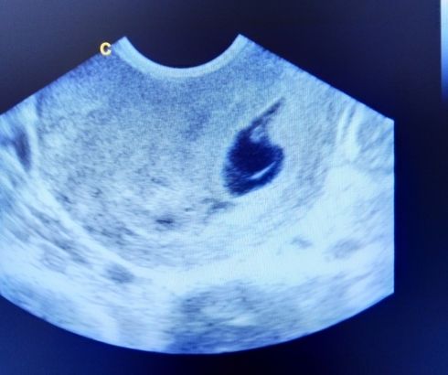 4 Weeks Pregnant Ultrasound 4 Weeks Pregnant Ultrasound