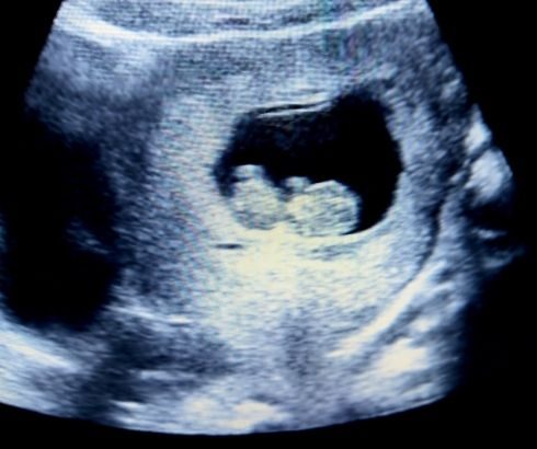 10 week pregnancy ultrasound