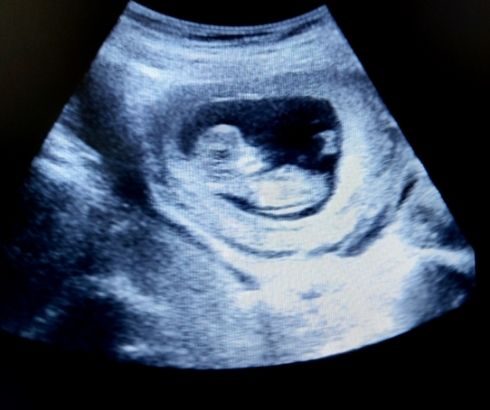 11 week pregnancy ultrasound