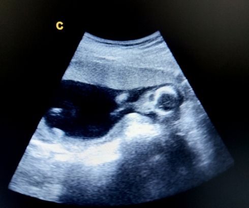 12 week pregnancy ultrasound