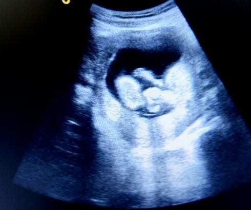 13 week pregnancy ultrasound