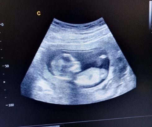 15 week pregnancy ultrasound