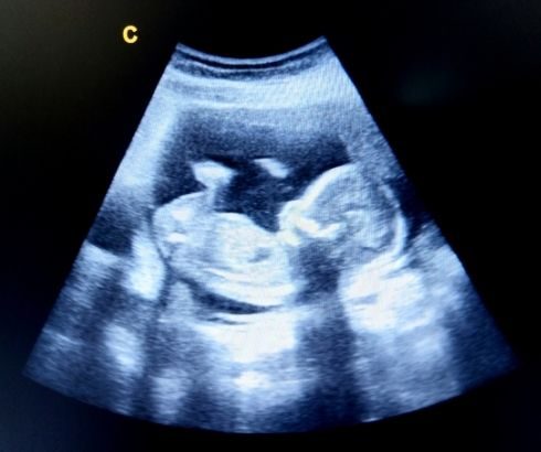 16 week pregnancy ultrasound