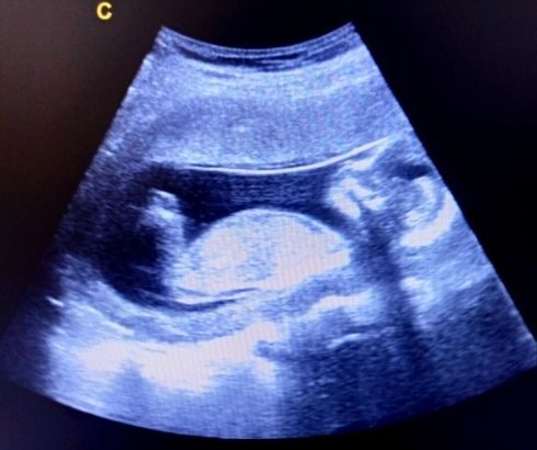 17 week pregnancy ultrasound