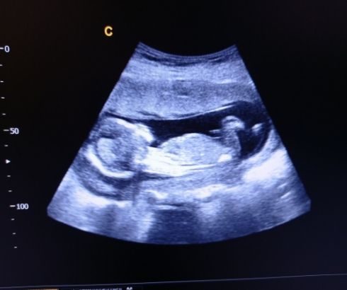 18 week pregnancy ultrasound