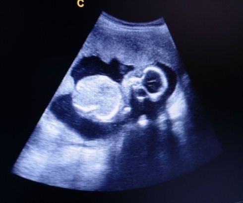 19 week pregnancy ultrasound