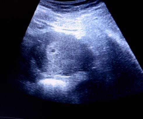 2 week pregnancy ultrasound