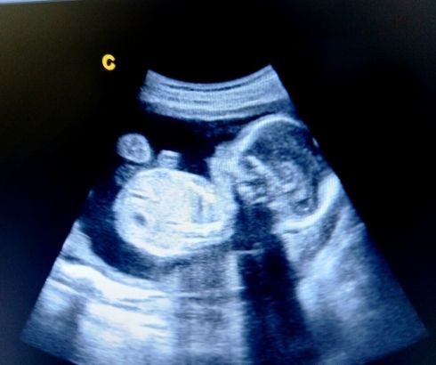 21 week pregnancy ultrasound