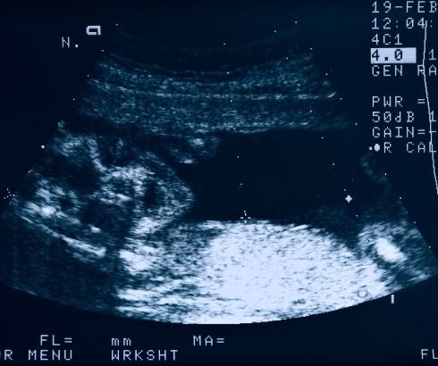 22 week pregnancy ultrasound