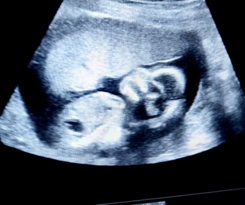 24 week pregnancy ultrasound