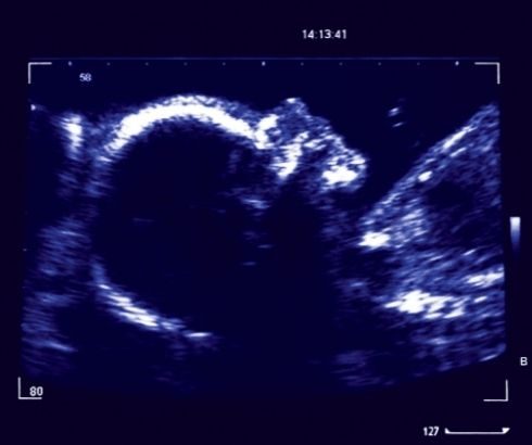 25 week pregnancy ultrasound