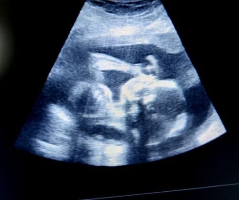 26 week pregnancy ultrasound