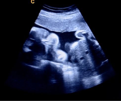 27 week pregnancy ultrasound