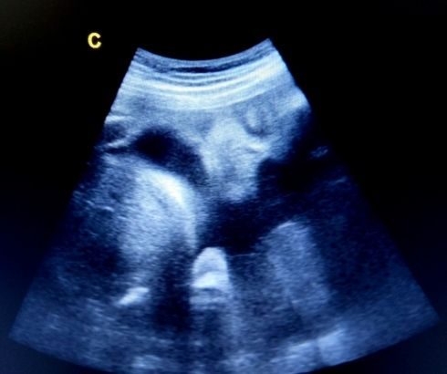 28 week pregnancy ultrasound