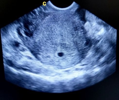3 week pregnancy ultrasound