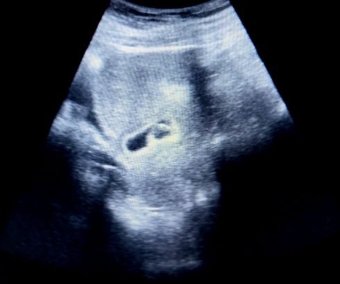 5 week pregnancy ultrasound