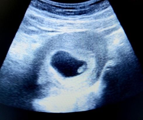 7 week pregnancy ultrasound