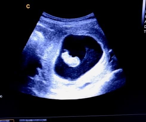 9 week pregnancy ultrasound